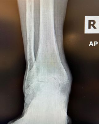 In Office X-Rays in Spring TX  No ER Broken Ankle CareLouetta Foot & Ankle  Specialists